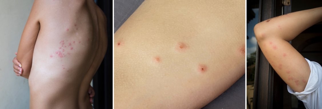 Следи от ухапвания от дървеници