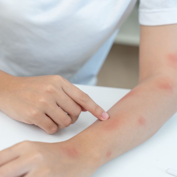 сърбежи по кожата причинени от кокошинки