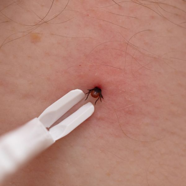 отстраняване на кърлеж