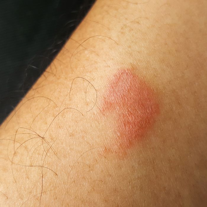 Ухапване от сколопендра симптоми и първа помощ